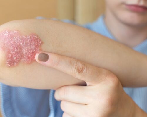 Psoriasis : How Homeopathy Offers a Natural Path to Healing